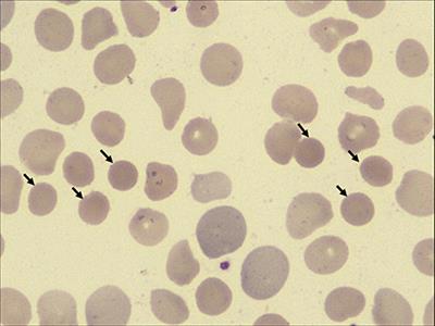 Transcatheter Closing Atrial Septal Defect in a Child With Hereditary Spherocytosis